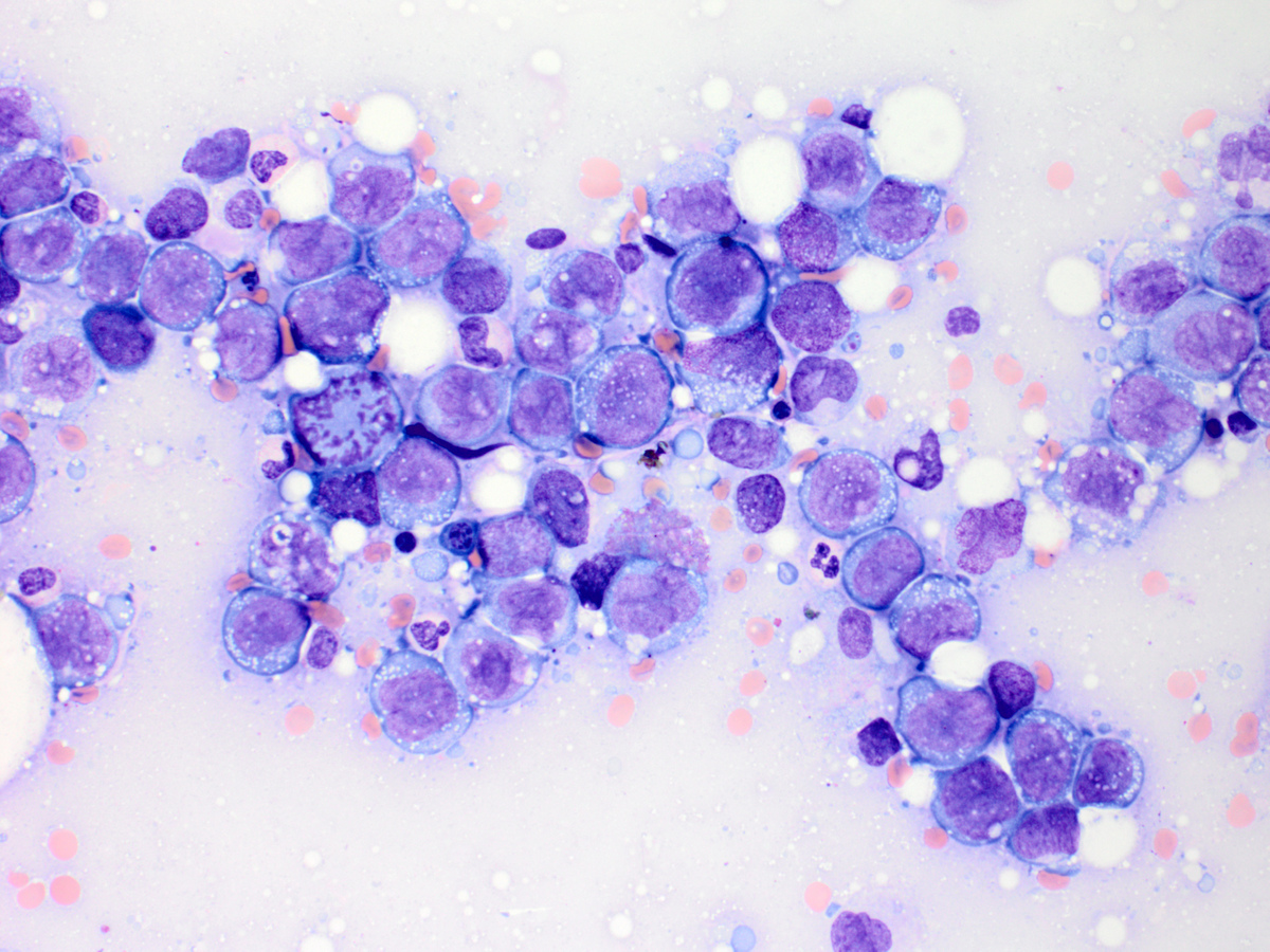 Touch preparation showing extensive population of immature cells with irregular nuclei and abundant basophilic cytoplasm with vacuoles and no Auer rods (x400, Wright-Giemsa)